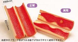 病変血管サンプル　（正常・異常）２本セット